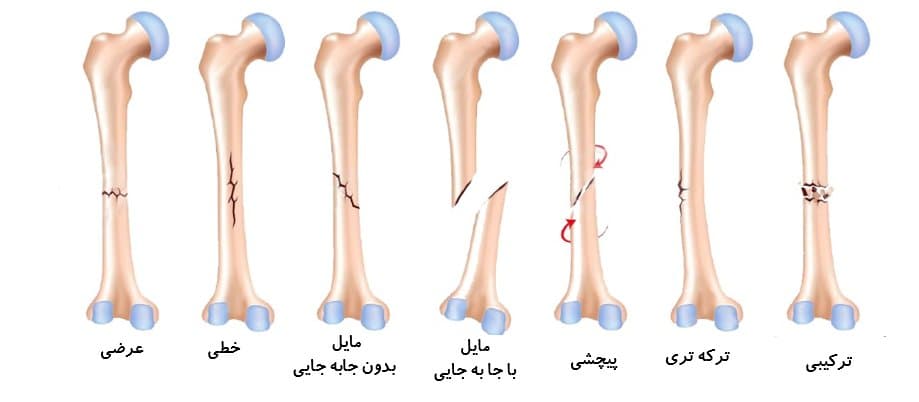 شکستگی استخوان و درمان سریع و آسان